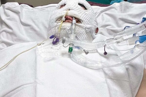 Gas can explosion left Idaho father in coma with severe burns; Fighting for Life