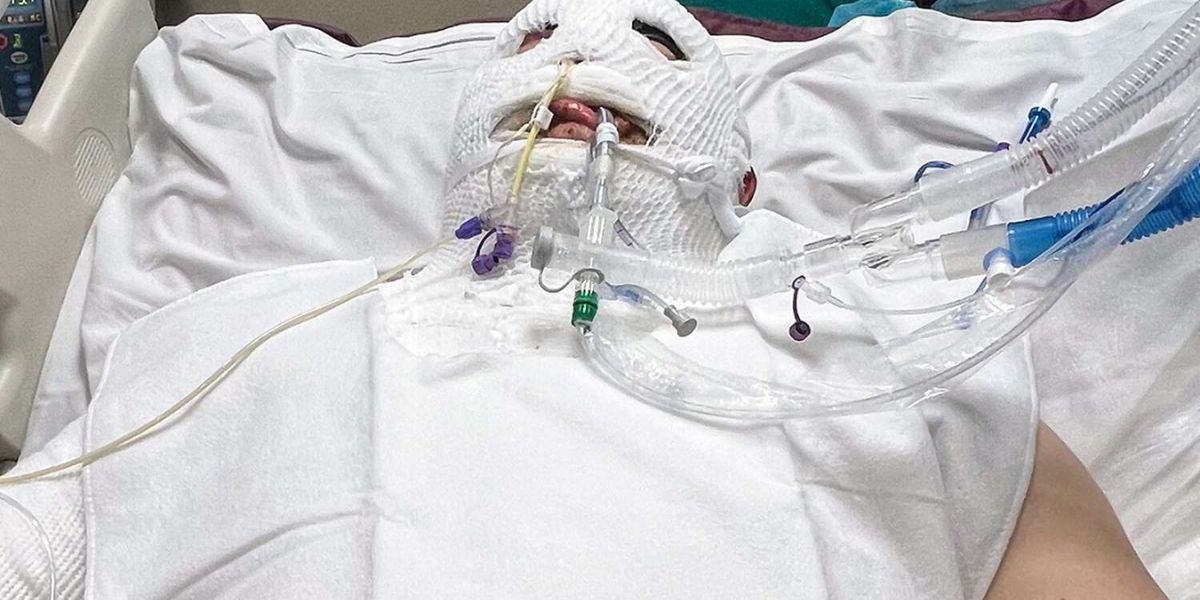 Gas can explosion left Idaho father in coma with severe burns; Fighting for Life
